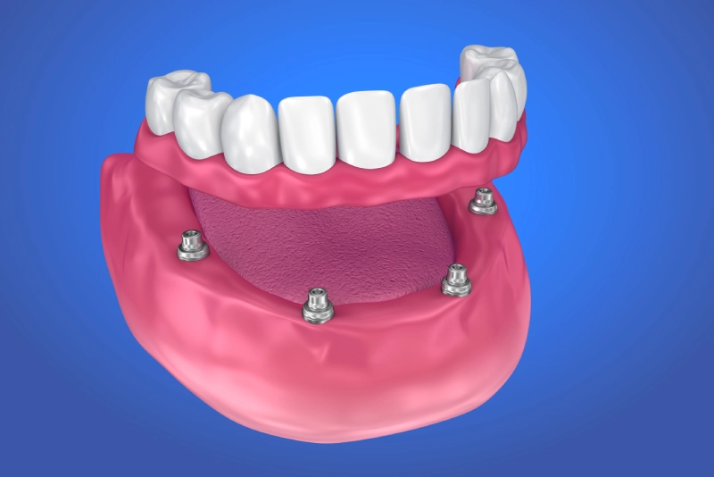 Dental Bridges
