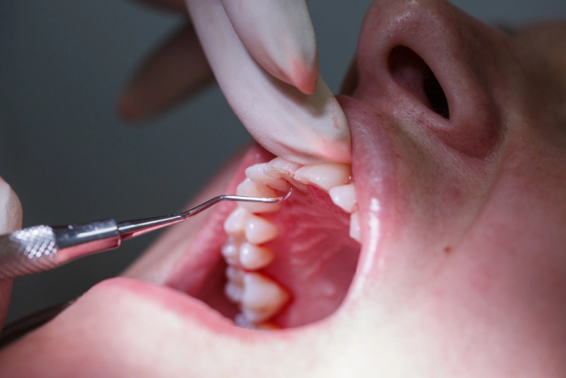 Periodontal Procedures